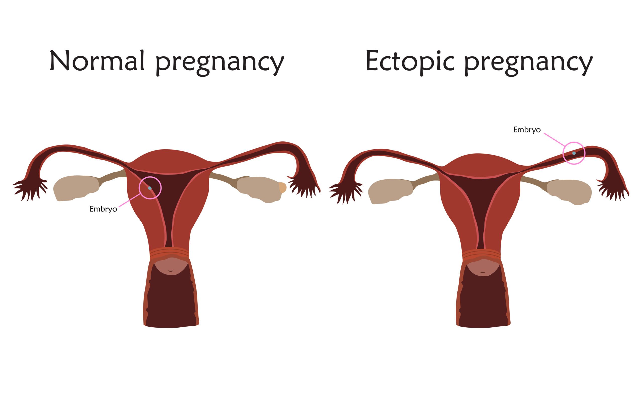 normal vs ectopic pregnancy